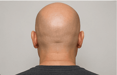 A person with a shaved head — completely bald
